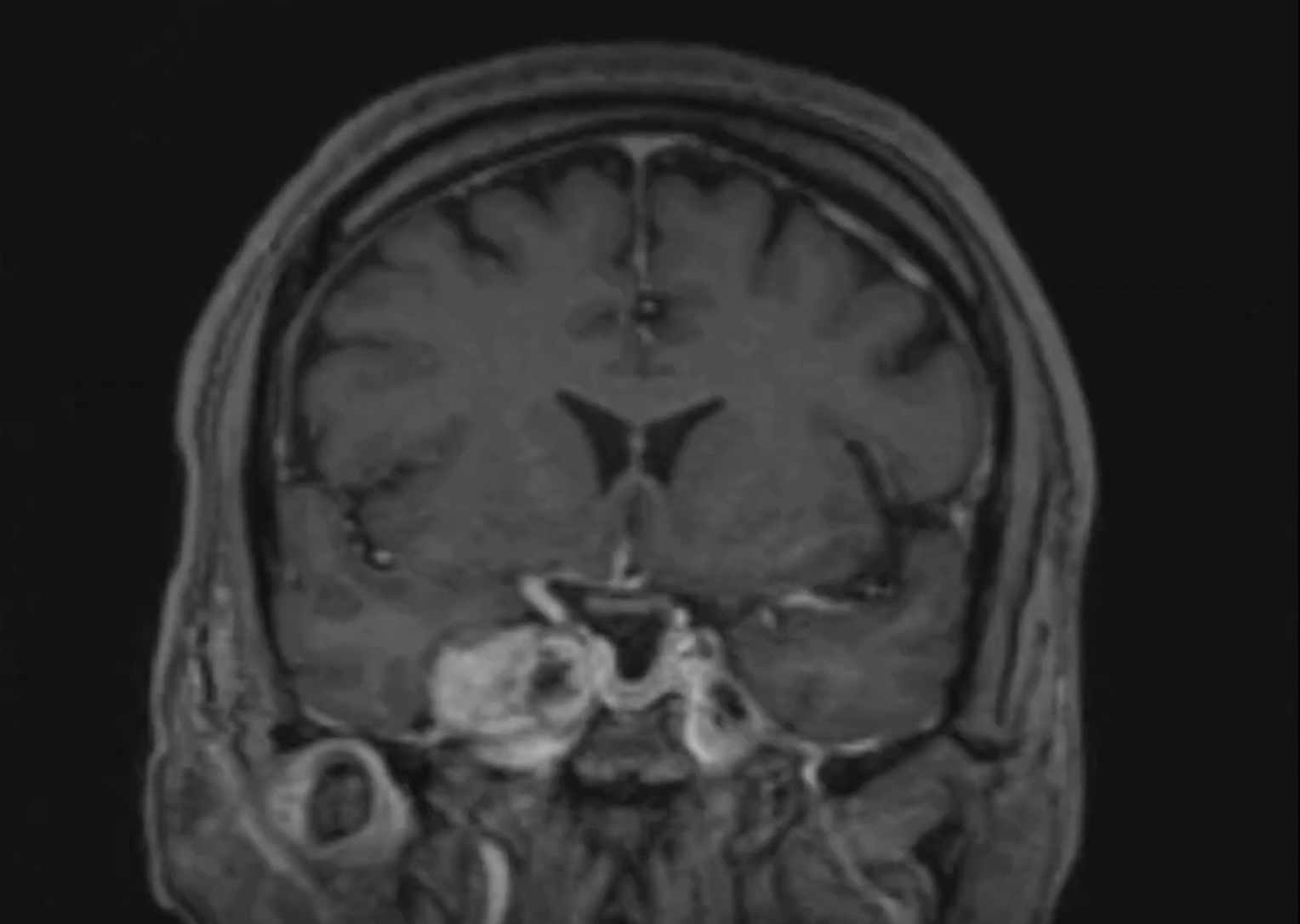 Trigeminal Schwannoma Cavernous Type-Superior Eyelid approach