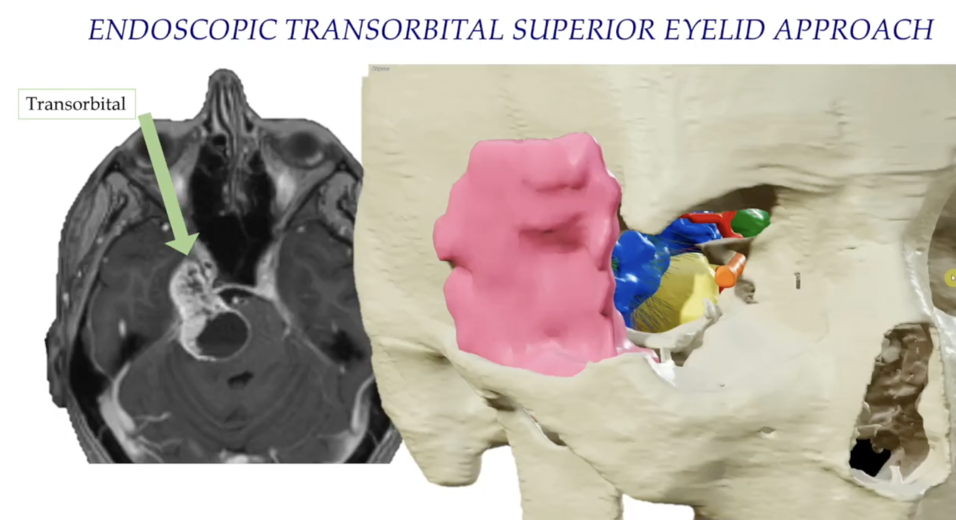Meckel's Cave Benign Tumor-Transorbital approach