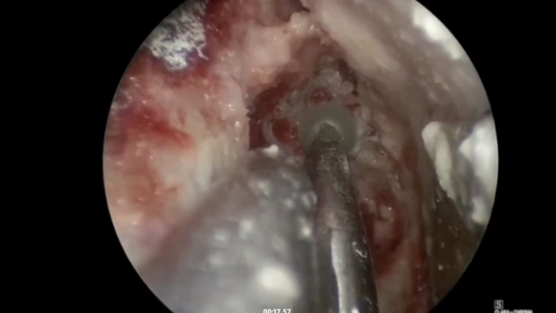 Repair of Lateral Sphenoid Encephalocele- Endoscopic Transorbital Approach Case 2